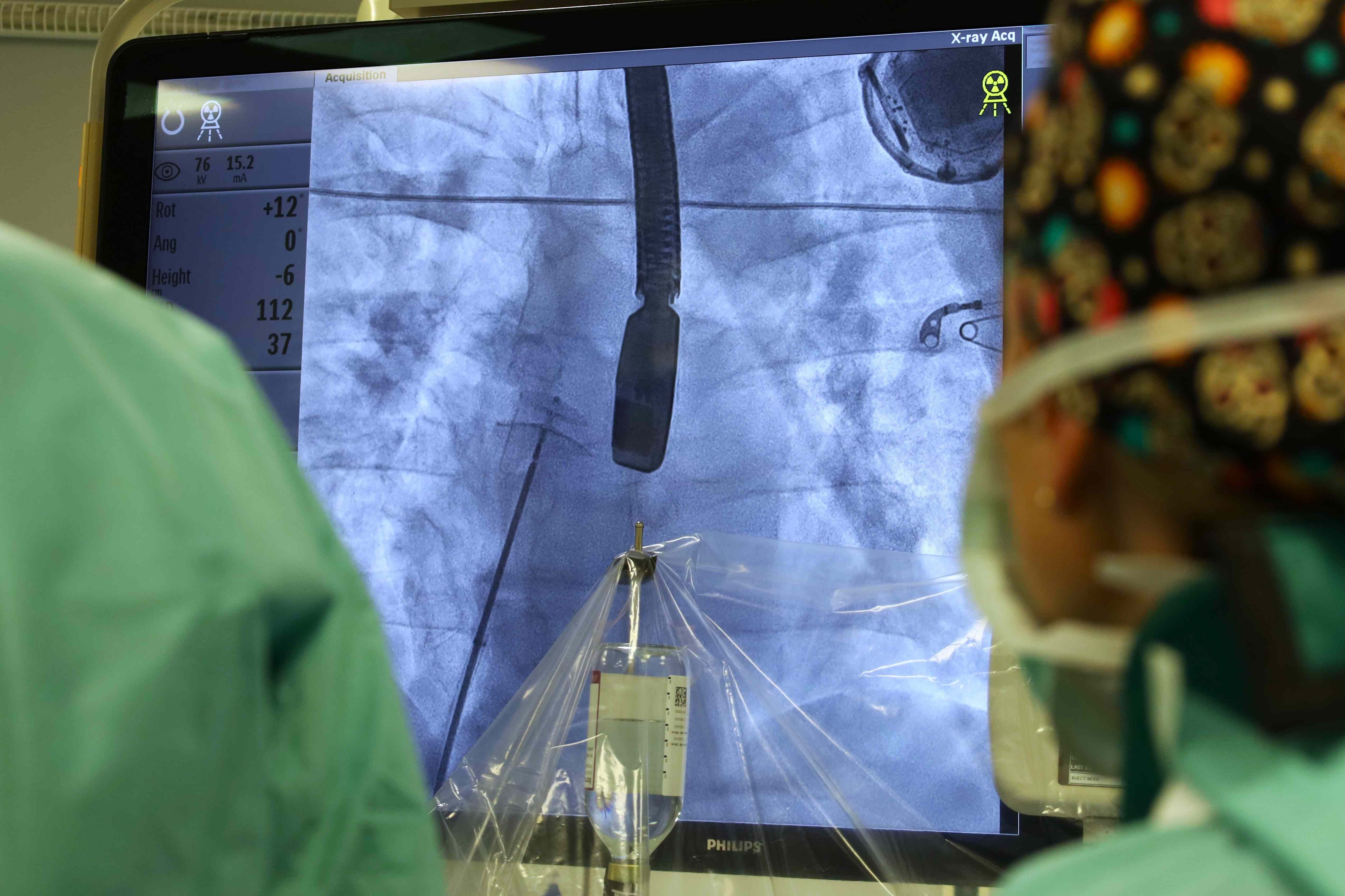 FNsP ZA_Štrukturálne intervenčné výkony umožňujú priamo riešiť anatomické odchýlky v srdci pacientov.JPG