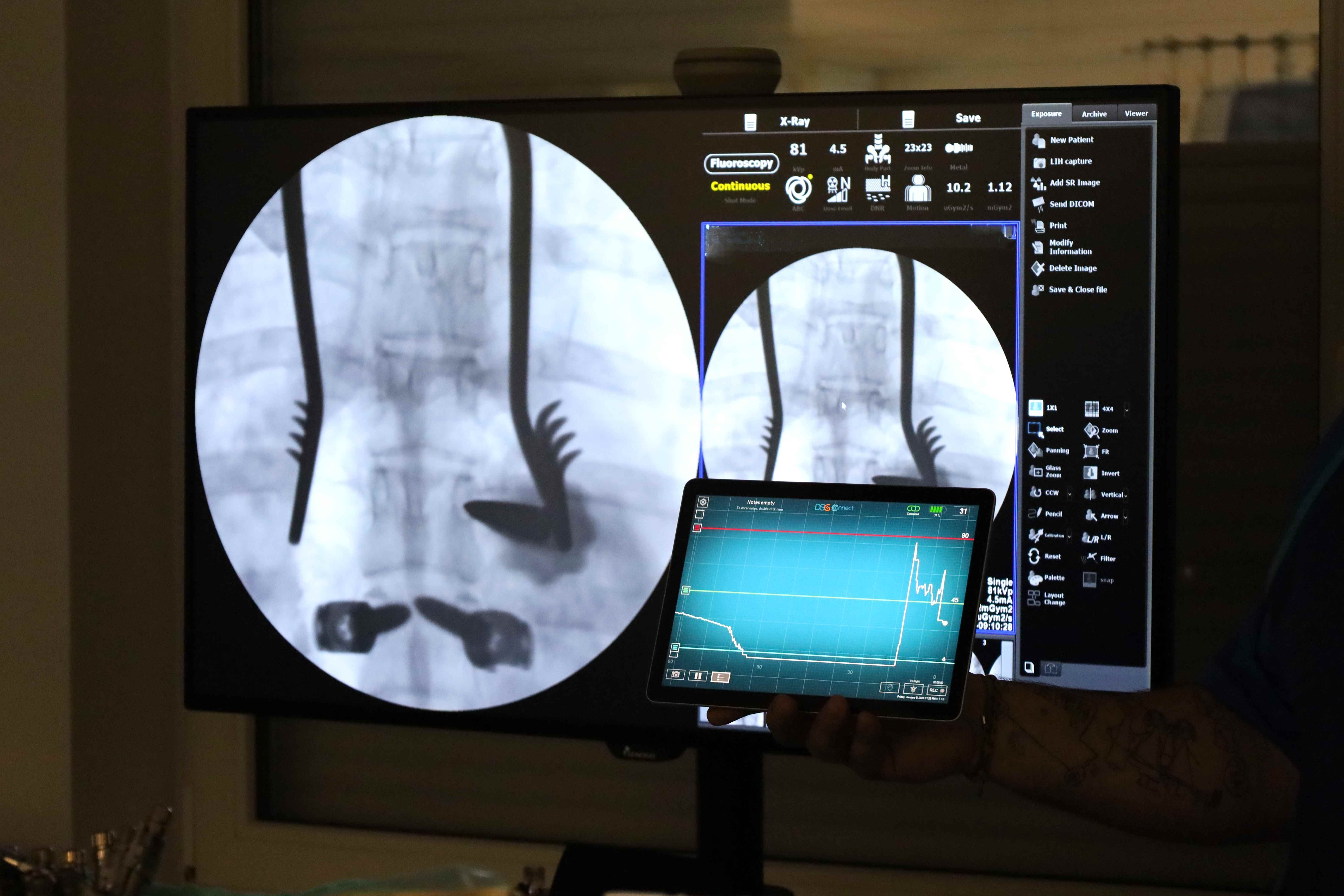 FNsP ZA_Žilinská nemocnica zaviedla do praxe nový robotický navigačný systém (002).JPG